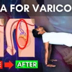 Yoga pose for varicocele relief Amit Namdev